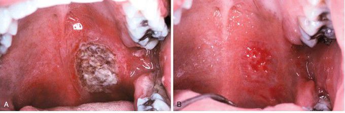 Necrotizing Ulcerative Mucositis