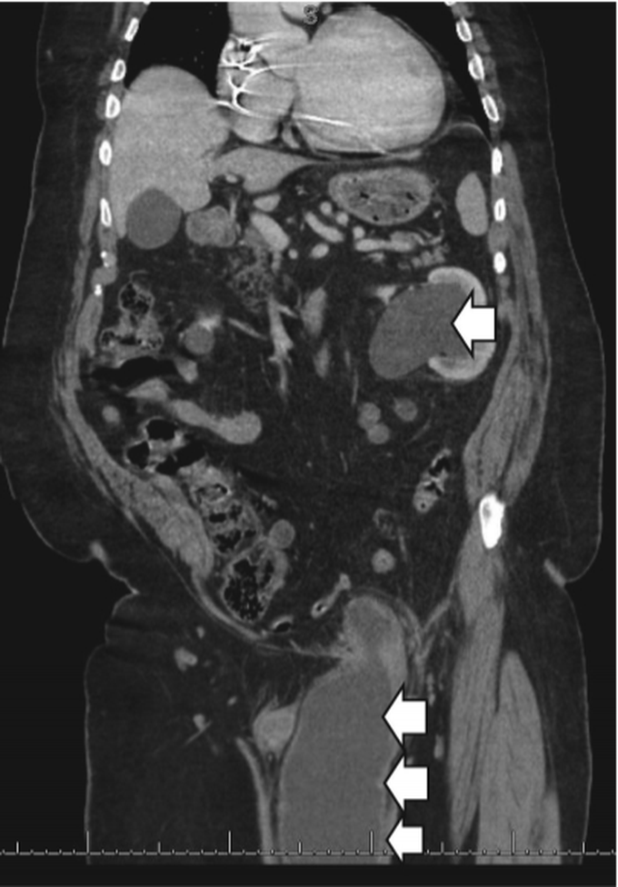 Acute Urinary Retention Secondary to Bladder Inguinal Hernia