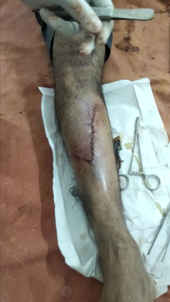 Injury by a tractor
