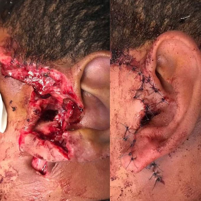 Interesting case of ear laceration! 