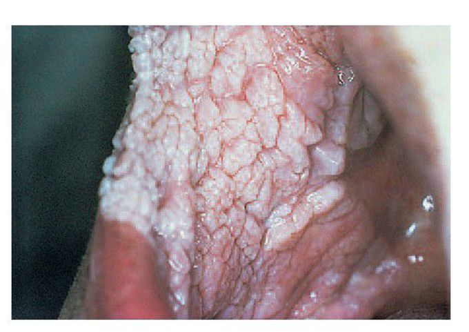 Verrucous carcinoma