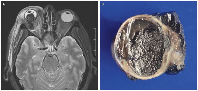 Metastatic Uveal Melanoma