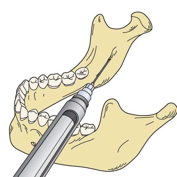 Inferior alveolar nerve block