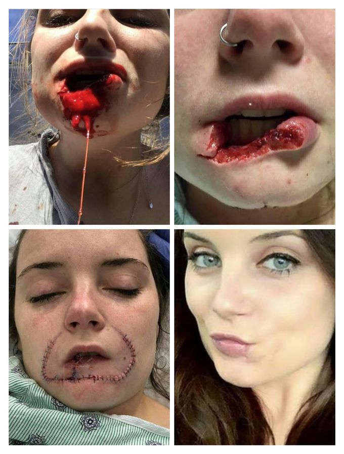 RIPPED OFF LOWER LIP!