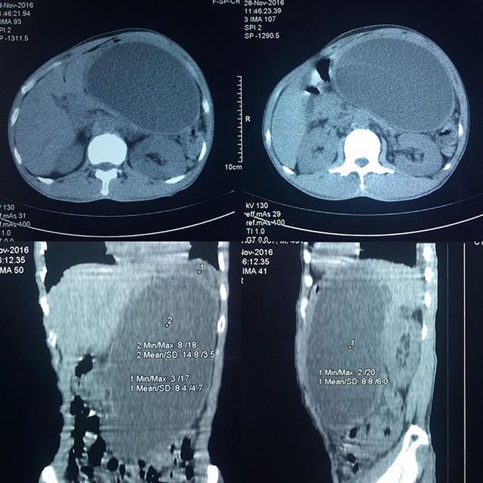 49 y.o male presenting with left abdominal mass, appeared following stab wound in left flank 2 months ago