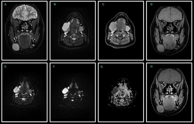 Diffusion-Weighted MR Imaging of the head and neck