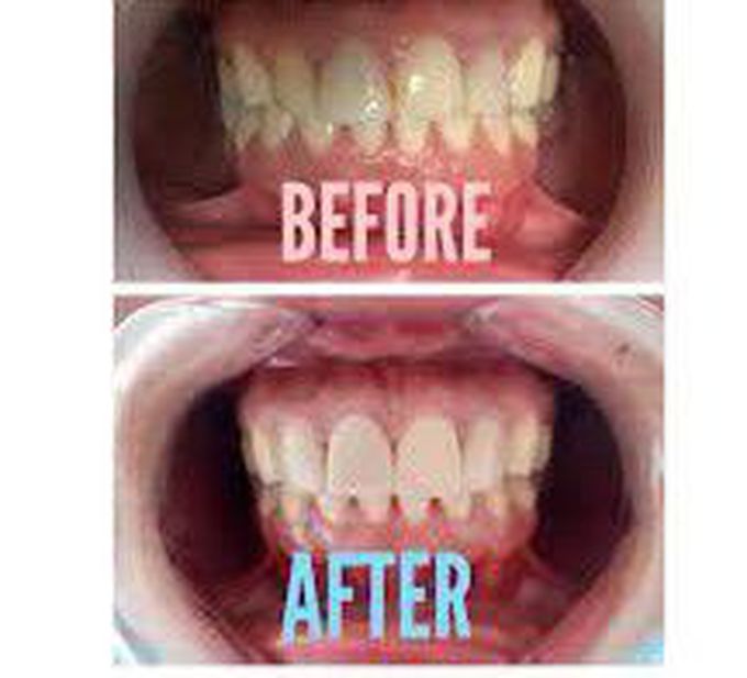 Gingivoplasty
