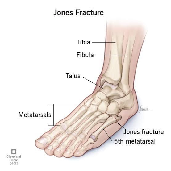 jones-fracture-medizzy