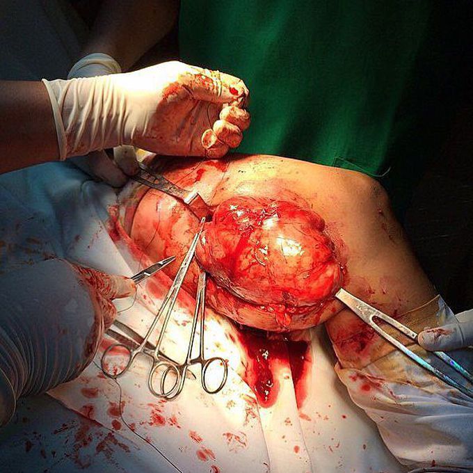 Soft tissue tumor