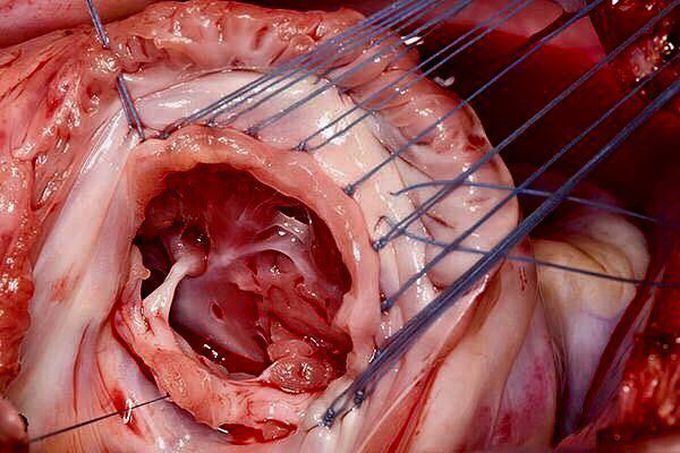 Tricuspic valve, The Heart ❤️
