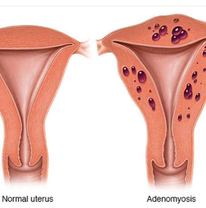 Adenomyosis