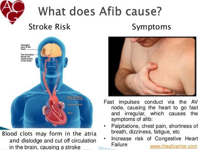 Atrial fibrillation