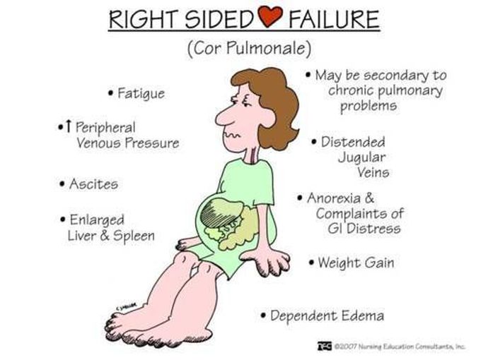 Signs and Symptoms of Right Sided Heart Failure