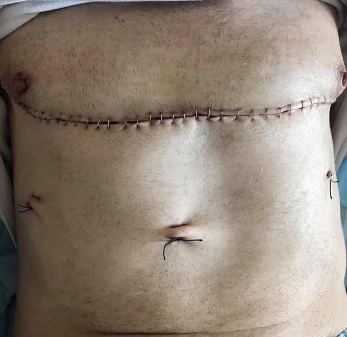 Clamshell incision