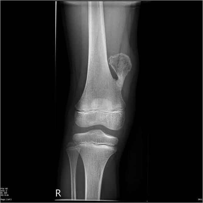 ✴️Osteochondroma