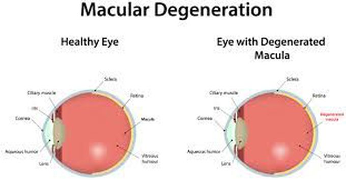 Macular degeneration