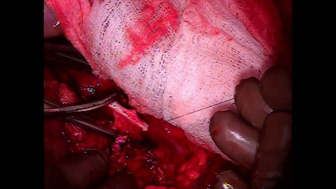 En Bloc Heart and Liver Transplant for the Failing Fontan