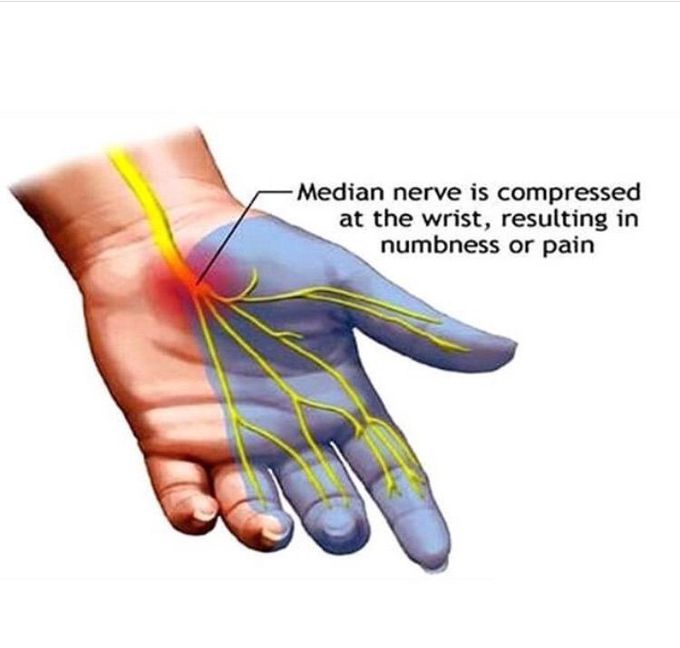 Carpal tunnel syndrom