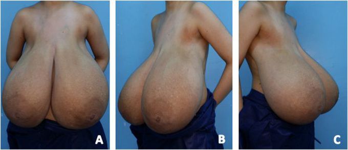 Diffuse Breast Hypertrophy