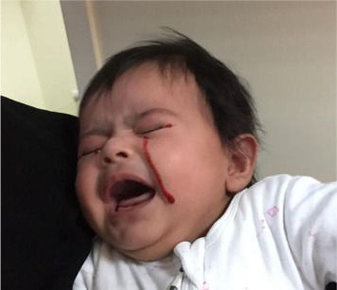 Haemolacria: Tears of Blood