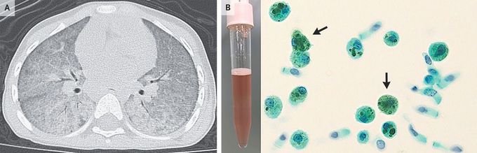 Idiopathic Pulmonary Hemosiderosis