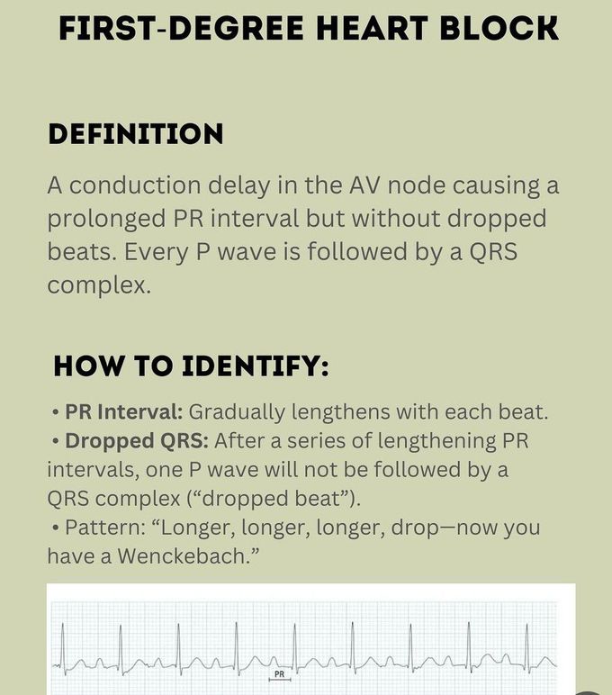 First Degree Heart Block I