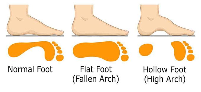 Flat Foot