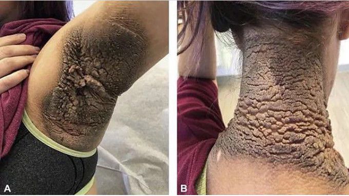 Acanthosis nigricans