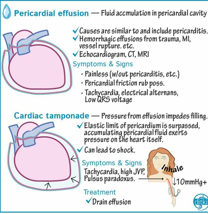 Pericardial effusion medizzy