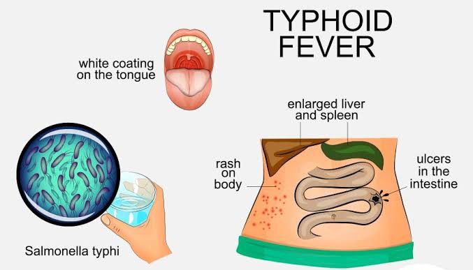 Typhoid fever - MEDizzy
