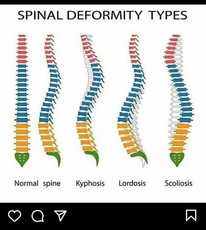 Spinal Deformity