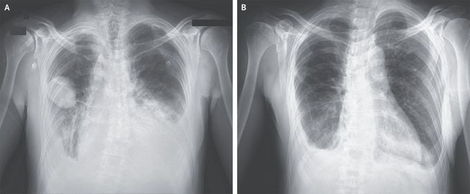 Phantom Tumor of the Lung