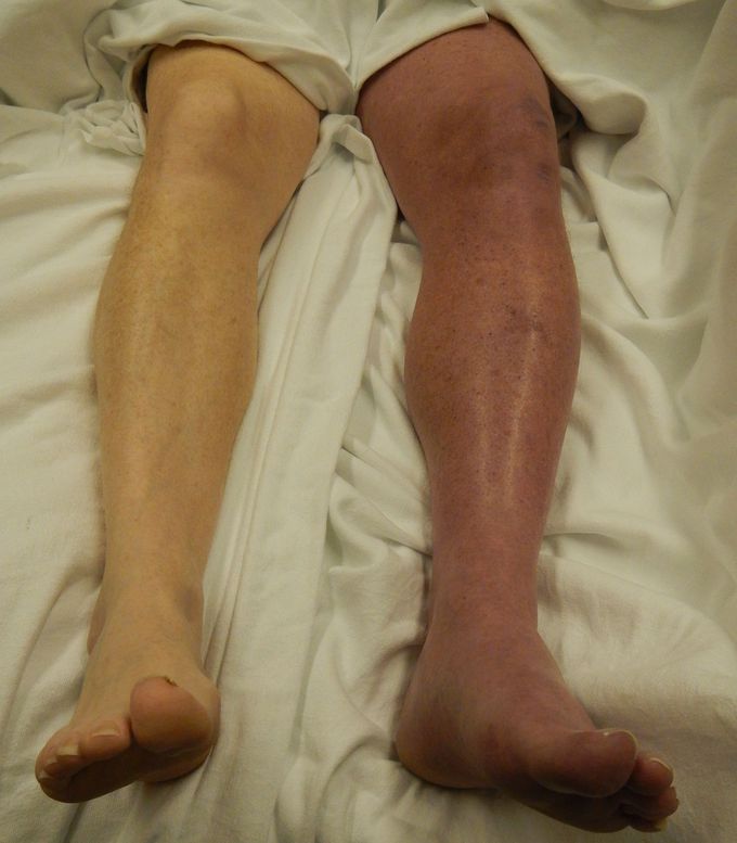 What is the diagnosis and complications?