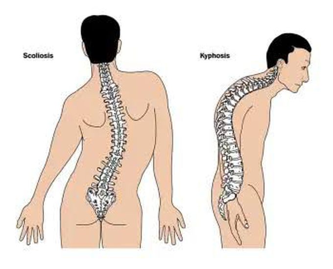 Symptoms of kyphosis