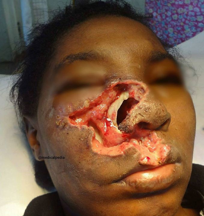 Rare case of mucormycosis- a fungal infection, affecting the right side of the patient's face!