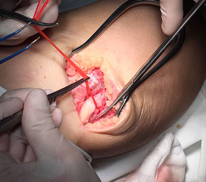 microsurgery