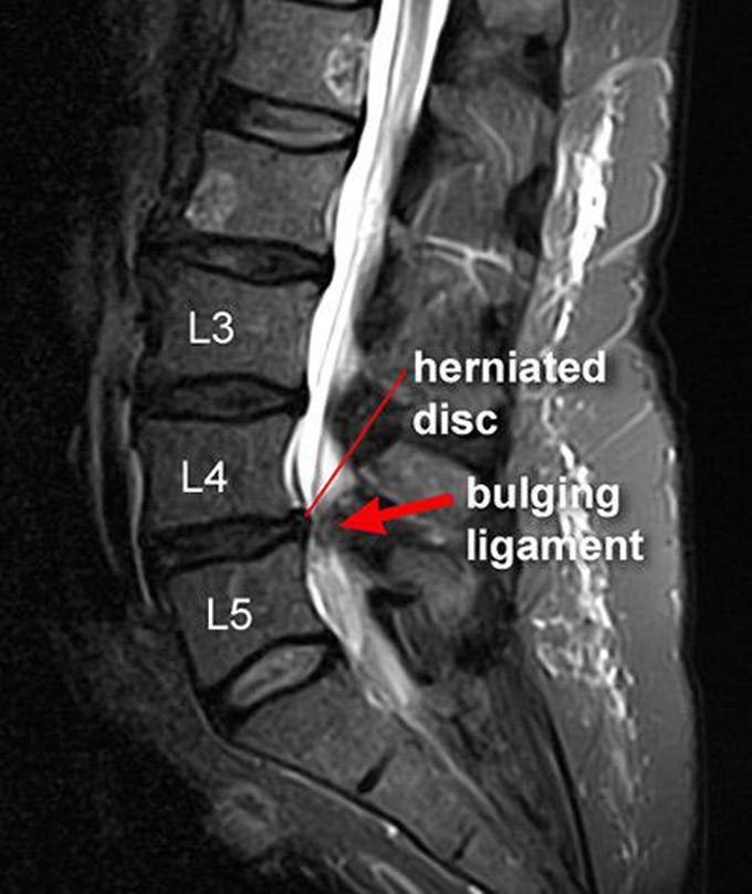 Herniated Disc