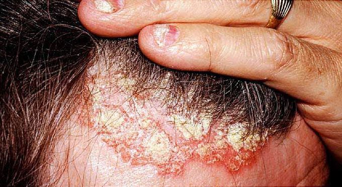 Scalp Psoriasis!!