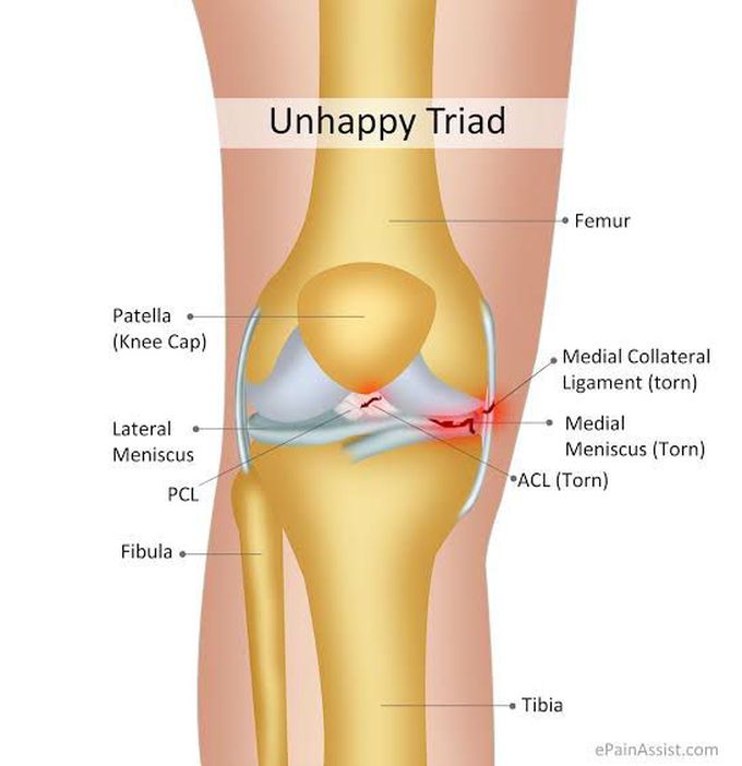 Unhappy triad of the knee- remember it by: MAM!