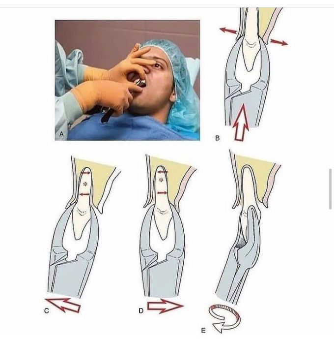 Forceps position for Maxillary Incisor extraction