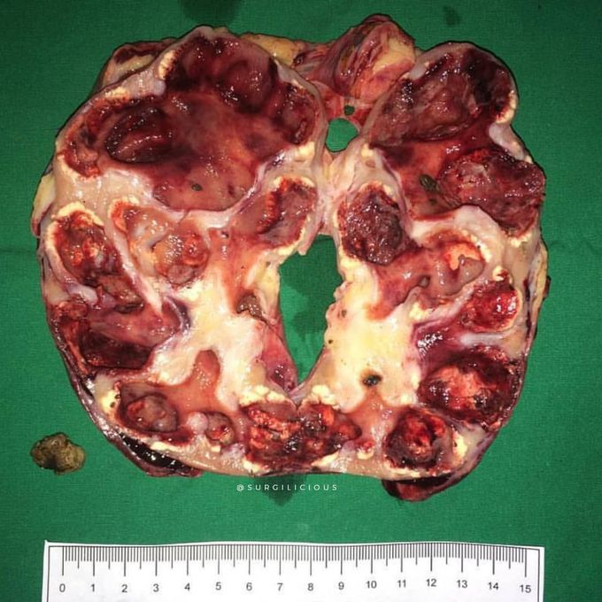 Hydronephrosis mistaken with pepperoni pizza