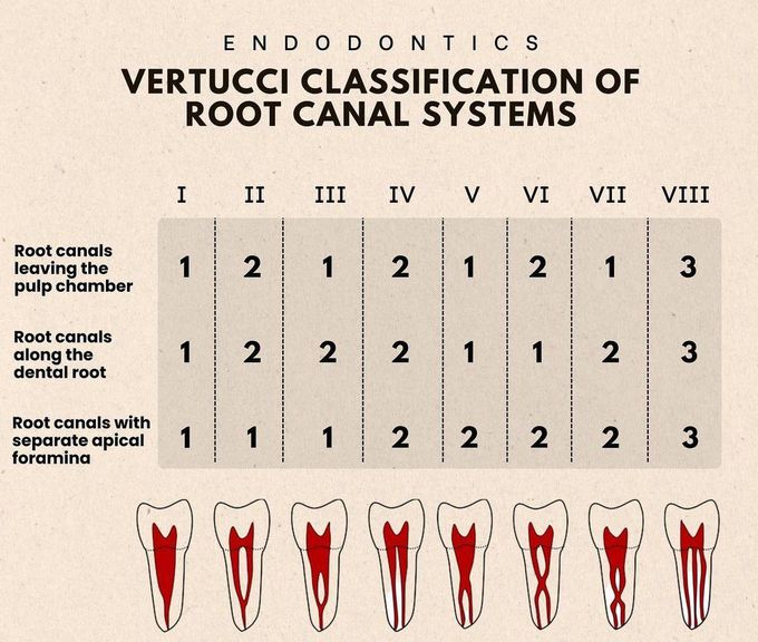 Vertucci Classification of Root Canal System