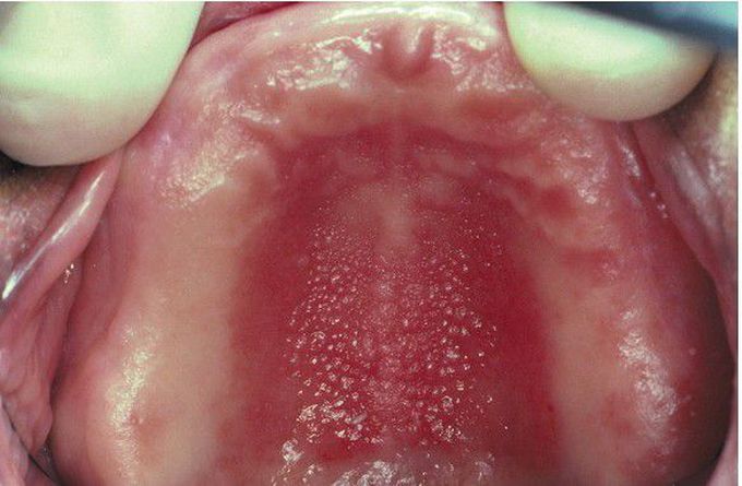 Inflammatory Papillary Hyperplasia