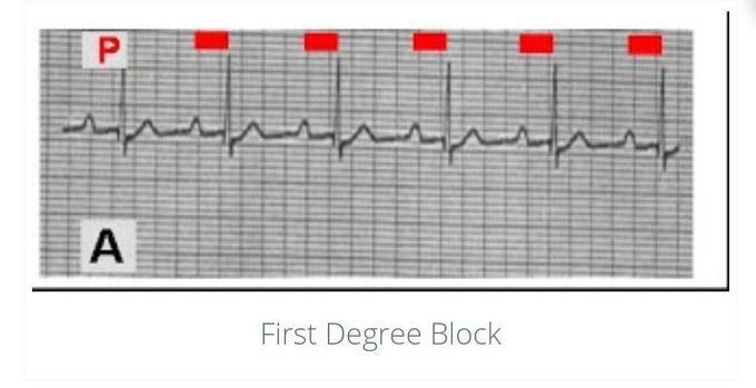 Heart Blocks