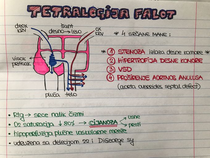 Tetralogy Fallot