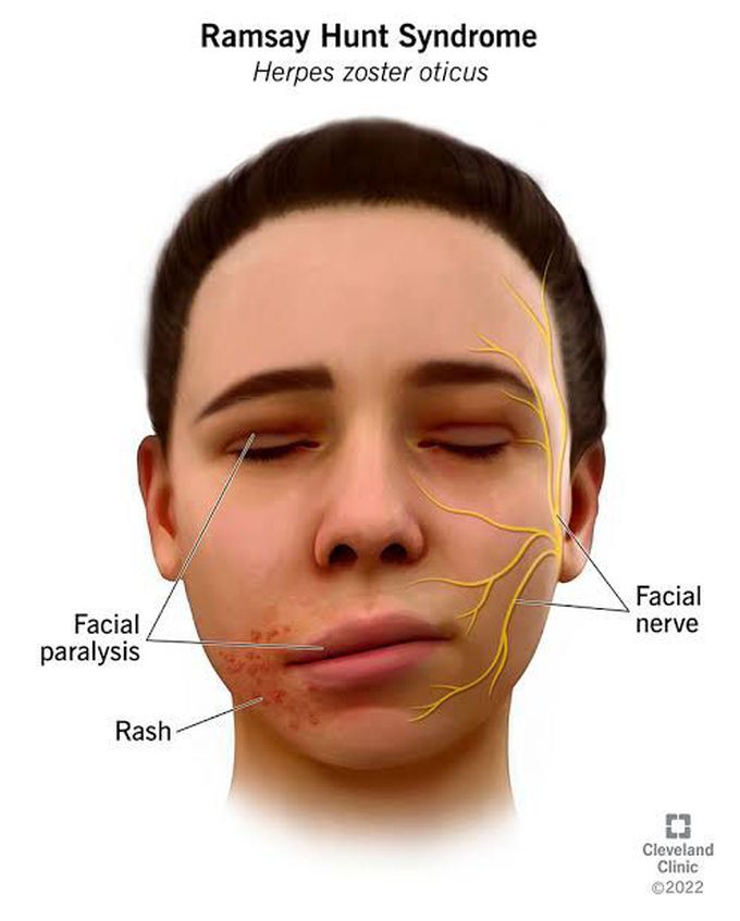 Ramsay Hunt syndrome