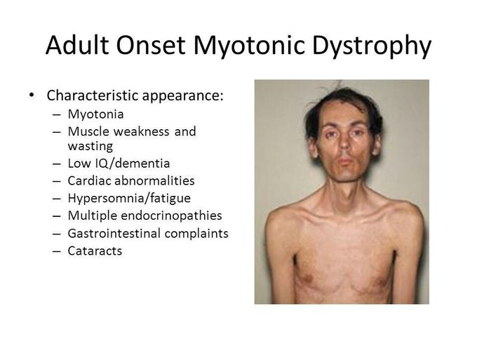 Myotonic Muscular Dystrophy Medizzy 4742