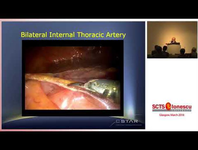 Robotic-Assisted Endoscopic CABG Surgery: Long Term Experience With Follow-Up