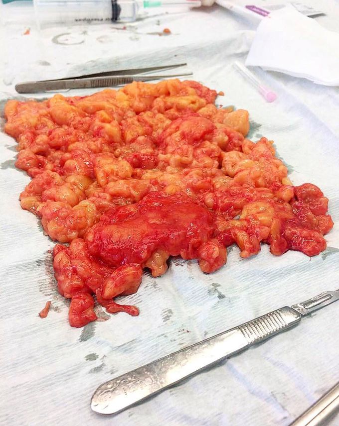 Lipoma