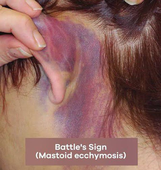 Battles sign